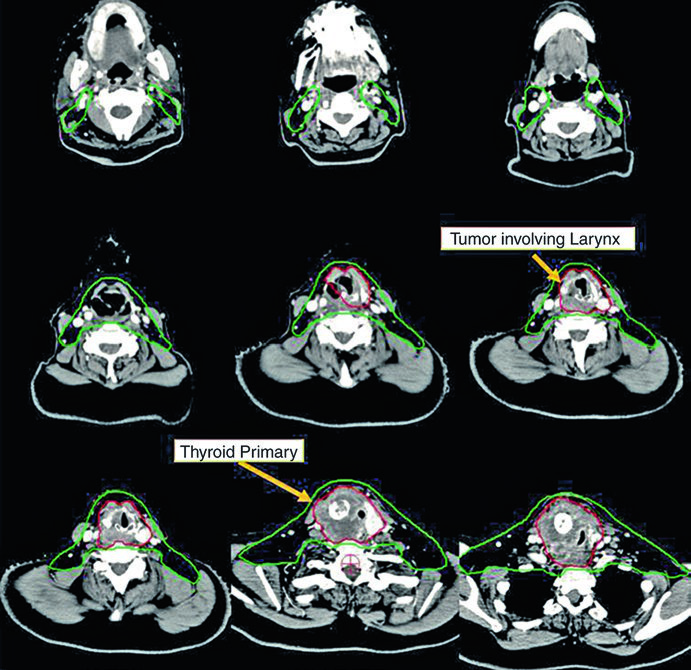 Câncer de Tireoide: Delineamento e Campos