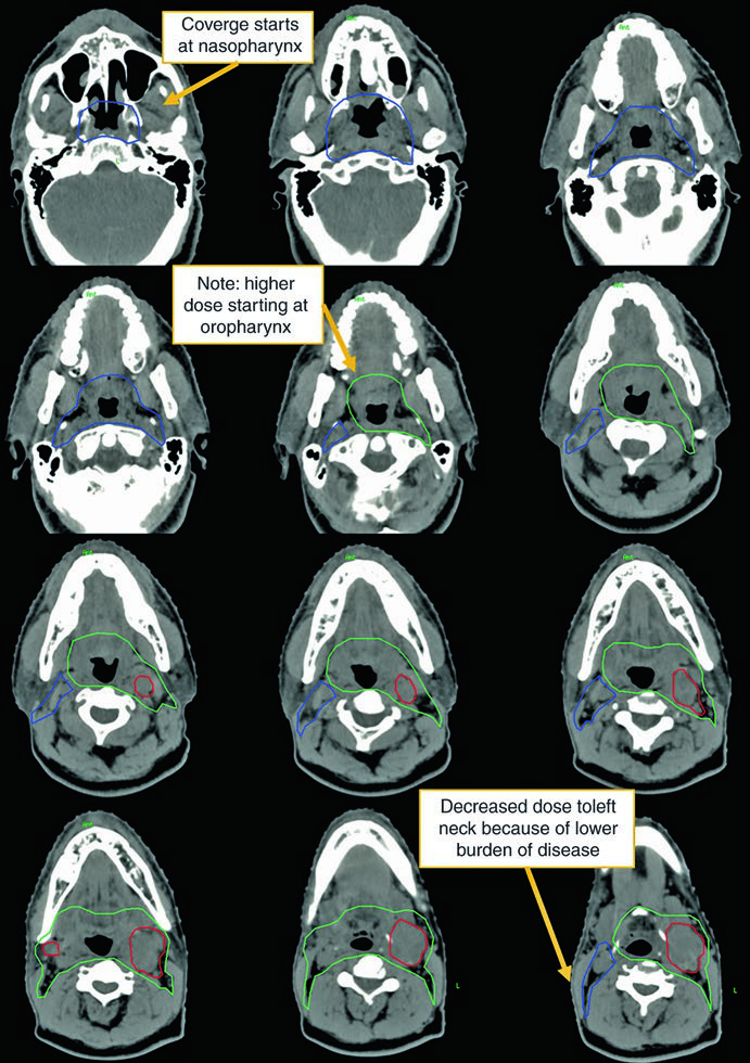 Montagem axial de tomografia no tratamento definitivo de primário oculto de cabeça e pescoço mostrando cobertura iniciando na nasofaringe e dose mais alta começando na orofaringe
