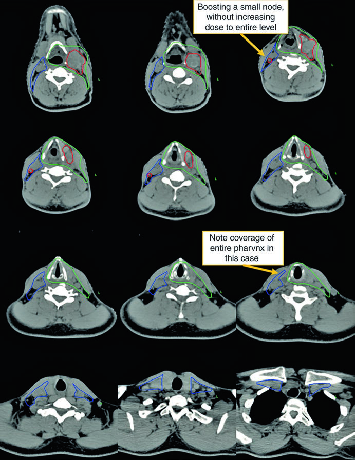 Montagem axial de tomografia em quimiorradioterapia definitiva para primário oculto mostrando boost em pequeno linfonodo sem elevar a dose de todo o nível e cobertura do eixo faríngeo inteiro