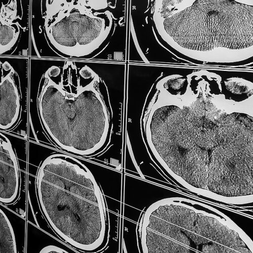 Vital Guard: IA para Achados Incidentais em Radiologia