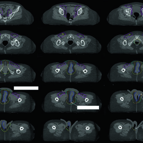 Câncer de Vulva: Delineamento e IMRT