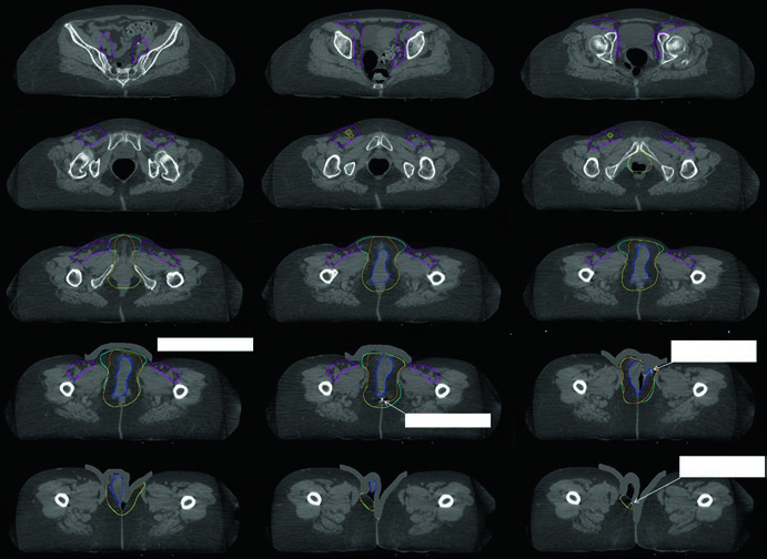 Câncer de Vulva: Delineamento e IMRT