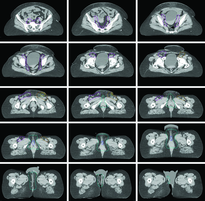Figura 23.2, radioterapia pós-operatória para câncer de vulva com volumes pélvicos, vulva e cadeias inguinofemorais em IMRT