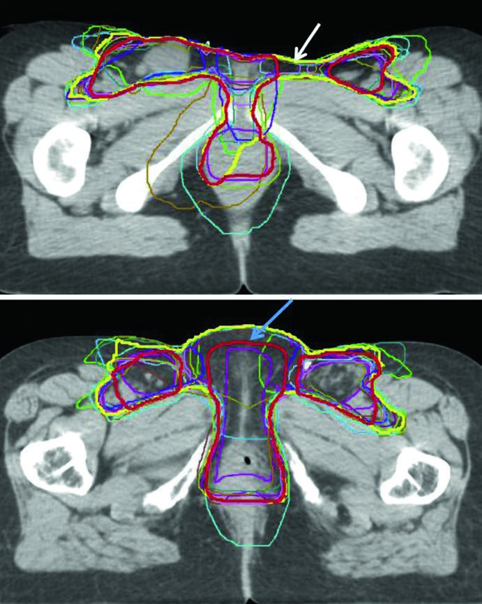 Comparação axial em TC entre contorno de consenso, consenso modificado e contornos individuais na delineação do câncer de vulva
