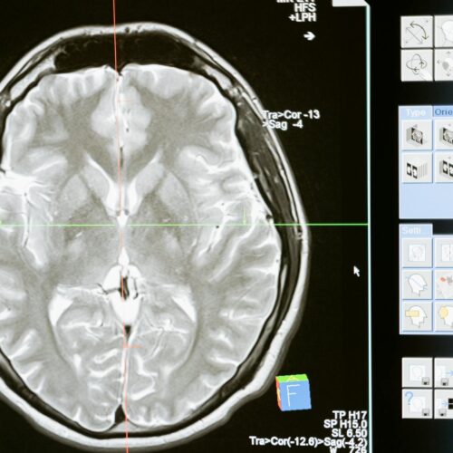 IA Supera Radiólogos en Cáncer de Páncreas Inicial