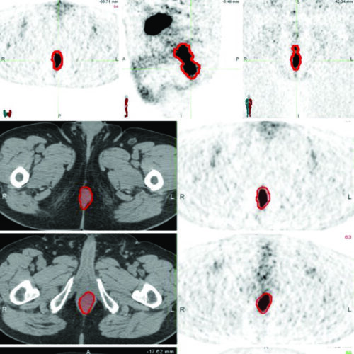 Câncer Anal: Delineamento de Volumes e Campos