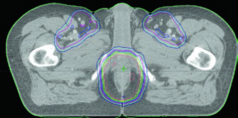 IMRT dose distribution for anal cancer showing pelvic and inguinal coverage