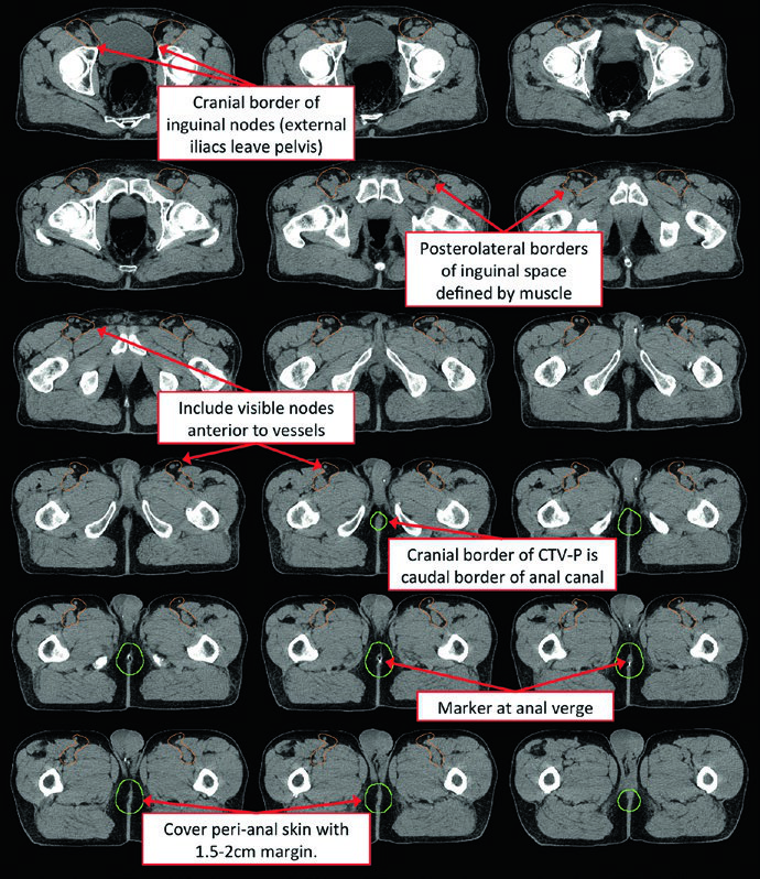 Postoperative case of pathologic T1 perianal squamous cell carcinoma showing CTV-P of the surgical bed and CTV-HR of inguinal nodes