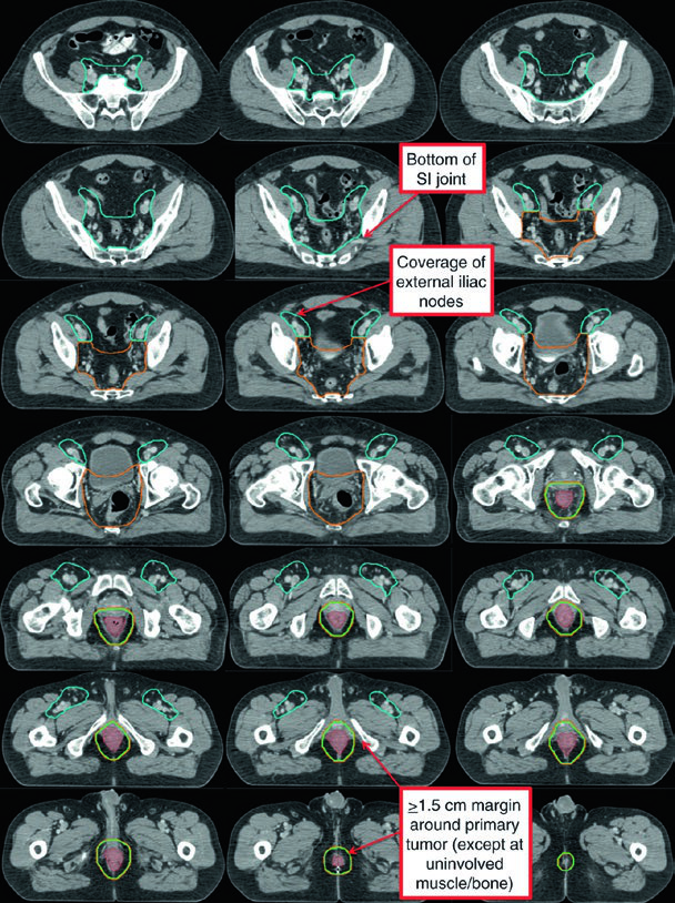 Clinical case T2N0 anal cancer showing CTV-LR, CTV-HR, CTV-P, and GTV-P on axial, sagittal, and coronal PET/CT slices
