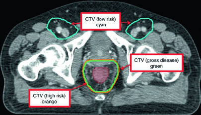 Magnified lower pelvis detail of T2N0 case showing CTV-LR, CTV-HR, CTV-P, and GTV in IMRT plan