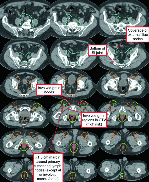 Clinical case T3N1a anal cancer with bilateral inguinal involvement showing CTV and GTV volumes on PET/CT slices