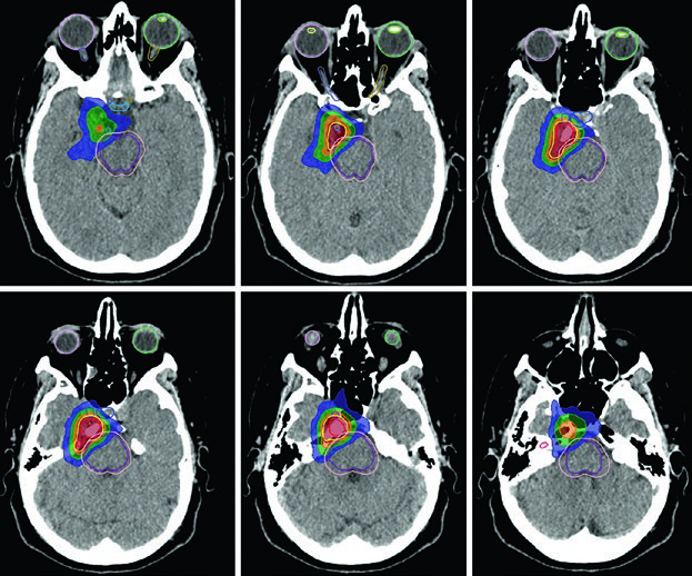 TC de planejamento para meningioma do seio cavernoso direito tratado com 52,2 Gy em 29 frações, com GTV, PTV e linhas de isodose coloridas, incluindo tronco encefálico, quiasma e nervos cranianos