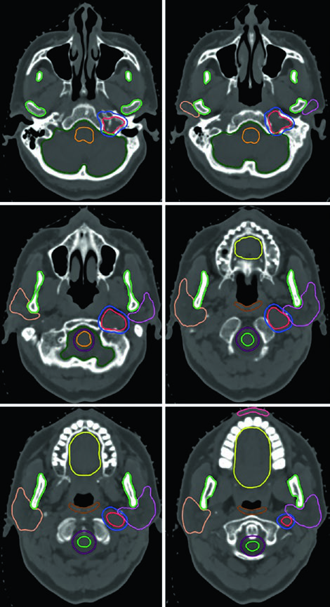TC em janela óssea de tumor glômico recorrente esquerdo no bulbo jugular após embolização e ressecção, tratado com 54 Gy em 30 frações, com GTV, PTV e múltiplos OARs delineados
