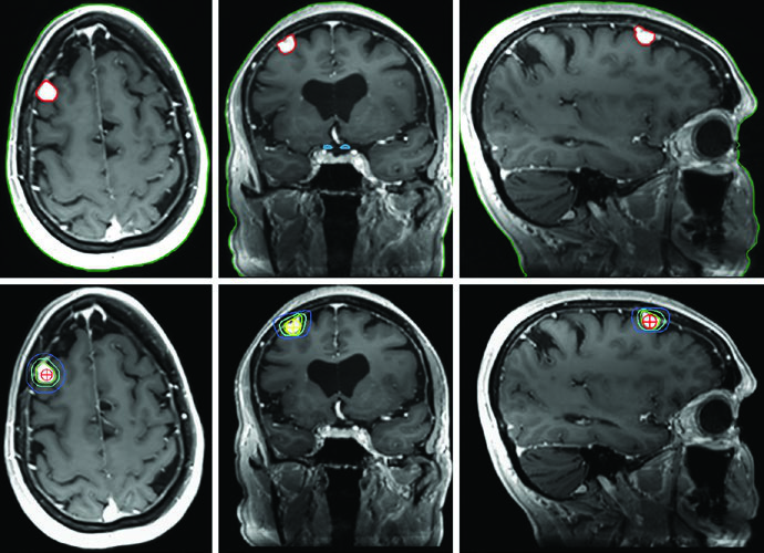 RM T1 pós-contraste de planejamento para meningioma de convexidade frontal direita tratado com SRS, mostrando GTV e linhas de isodose de 14 Gy, 8 Gy e 4 Gy