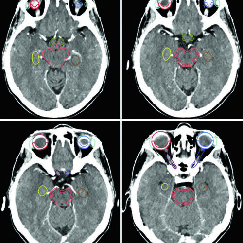 Tumores Benignos do SNC: Delineamento e RT