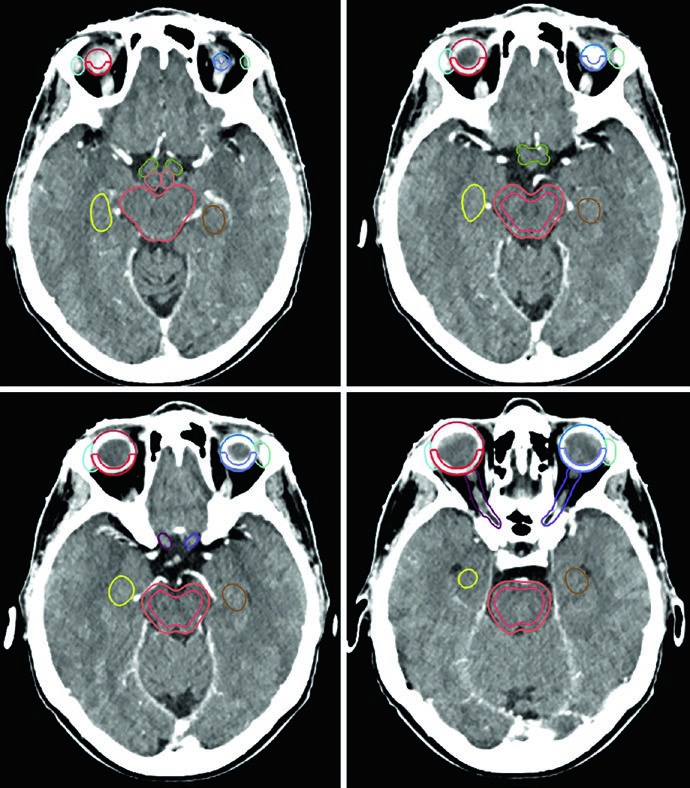 Cortes axiais de TC de simulação em janela cerebral mostrando órgãos de risco delineados para tumores cerebrais primários, incluindo tronco encefálico, quiasma óptico e hipocampo