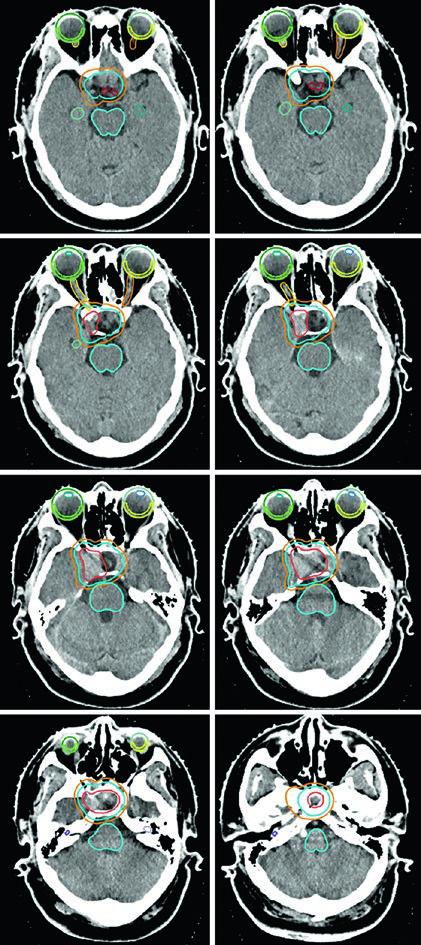 TC de planejamento para adenoma hipofisário não secretor pós-ressecção com GTV, CTV com margem de 0,5 cm e PTV com margem de 0,3 cm, mostrando tronco encefálico e nervos ópticos delineados