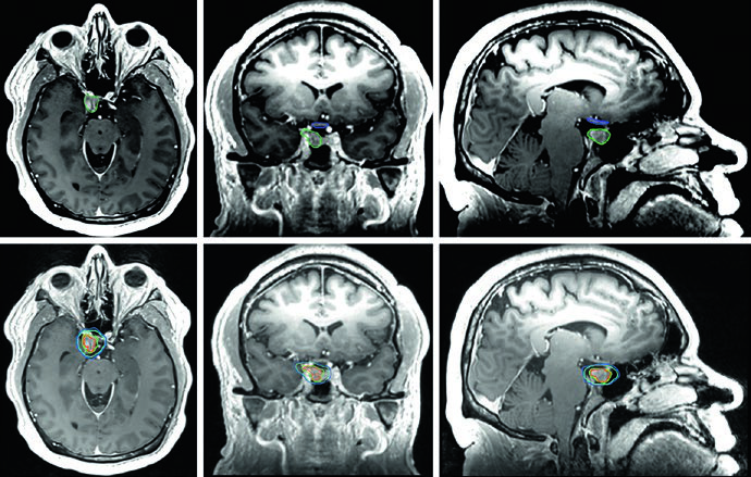RM T1 pós-contraste axial, coronal e sagital de adenoma hipofisário secretor de GH tratado com SRS a 24 Gy, com linhas de isodose e quiasma óptico delineado