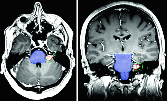 RM T1 pós-contraste axial e coronal de schwannoma cerebelopontino esquerdo com extensão para o canal auditivo interno, mostrando linhas de isodose de 12,5 Gy, 20 Gy e 5 Gy