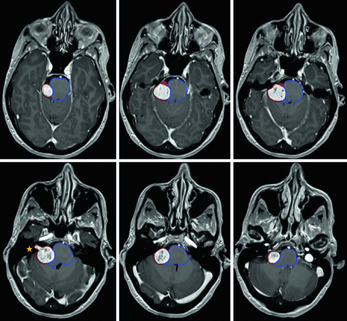 RM T1 pós-contraste axial mostrando schwannoma vestibular no ângulo cerebelopontino direito comprimindo o pedúnculo cerebelar e ponte, com GTV delineado