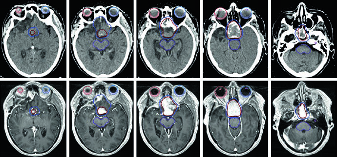 TC e RM de planejamento para meningioma grau 1 selar e suprasselar volumoso com doença residual significativa após debulking