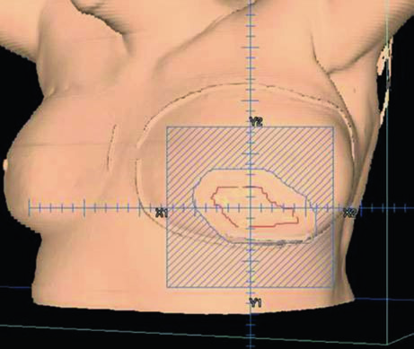 3D view of electron boost field to the tumor bed showing custom cutout, surgical clips, and lumpectomy scar in breast radiotherapy
