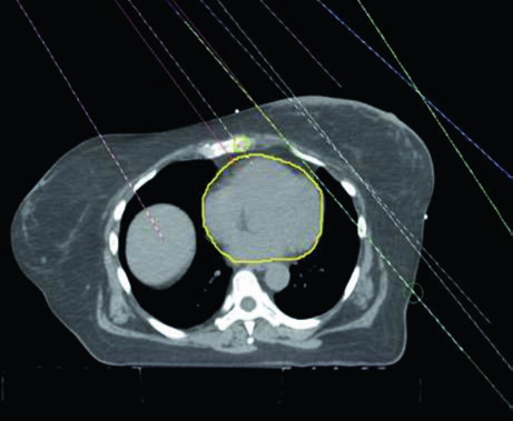 Axial view showing three-beam arrangement for 3D conformal breast radiotherapy: medial en face electron beam and opposing lateral tangent fields