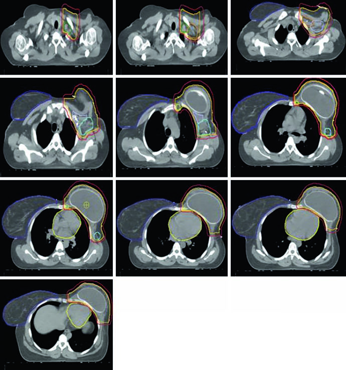 Axial slices of target delineation for reconstructed left chest wall with tissue expander showing volumes and nodal stations