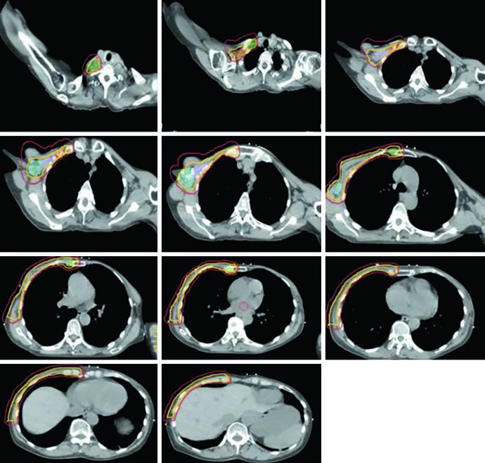 Axial slices of target volume and nodal delineation for unreconstructed right chest wall in cranio-caudal direction