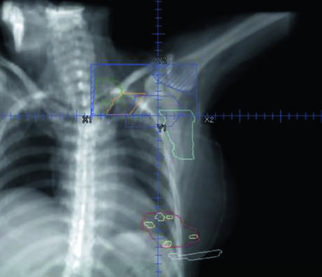 Coronal view of supraclavicular field with overlaid lymph node target volumes in breast radiotherapy