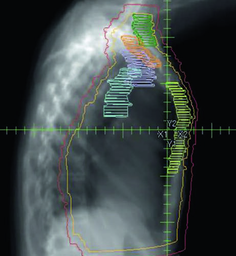 Irradiação Nodal Regional na Mama: Delineamento