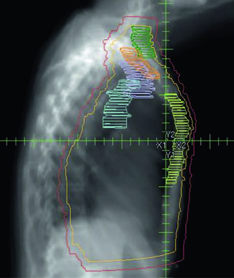 Coronal view of regional nodal breast irradiation target delineation showing PTV, CTV, axillary levels I-III, supraclavicular and internal mammary nodes