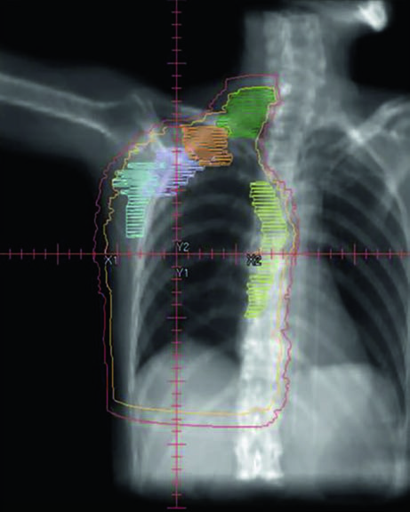 Sagittal view of breast regional nodal irradiation planning showing PTV and axillary and supraclavicular nodal levels