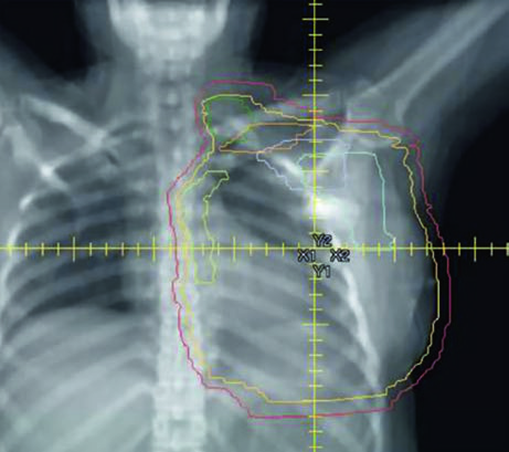 Sagittal view of irradiation planning with tissue expander in reconstructed left chest wall showing PTV, nodal levels, and organs at risk