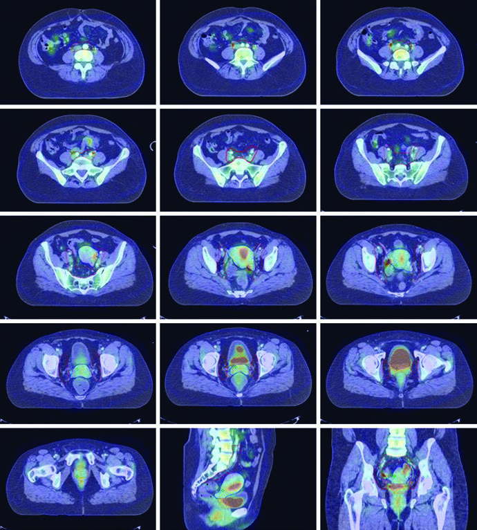 Representative CT simulation slices for FIGO IB1 cervical squamous cell carcinoma with fused PET/CT, showing CTV1 (blue), CTV2 (orange), and CTV3 (red) — pelvic IMRT 45 Gy in 25 fractions followed by HDR boost 28 Gy in 4 fractions