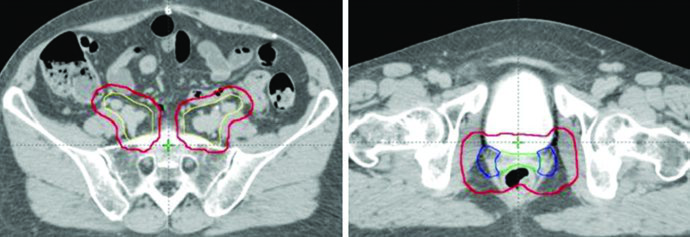 Final PTV combining PTV1 PTV2 and PTV3 in postoperative endometrial cancer patient planning
