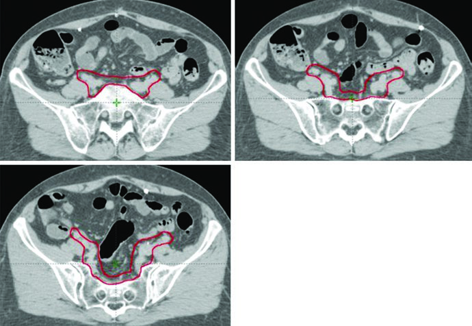 Modified CTV3 in endometrial cancer patient with cervical stromal invasion showing inclusion of the presacral region