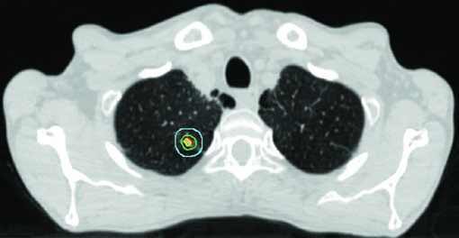 Planejamento SBRT de CPNPC periférico estádio inicial