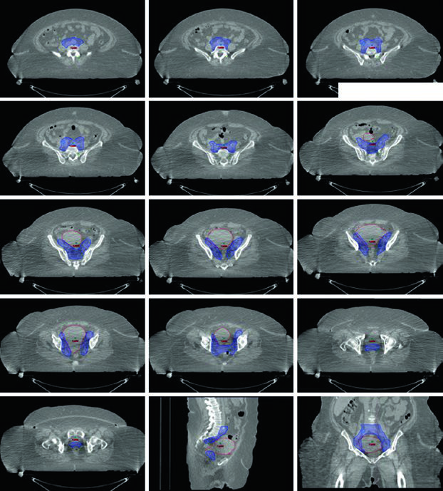 CT simulation slices for medically inoperable FIGO IB endometrial cancer with pelvic adenopathy showing CTV1 (red), nodal CTV (dark blue), and CTV boost (light blue) — 50.4 Gy in 28 fractions with nodal boost to 56.4 Gy and HDR 20 Gy in 5 fractions