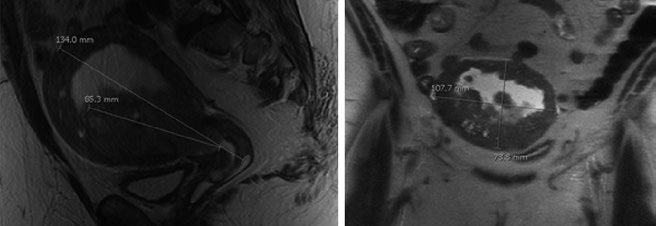 Pre-treatment pelvic MRI sagittal and coronal views of a medically inoperable FIGO IA endometrial cancer patient showing a 7.0 × 4.7 × 0.5 cm mass with deep myometrial invasion