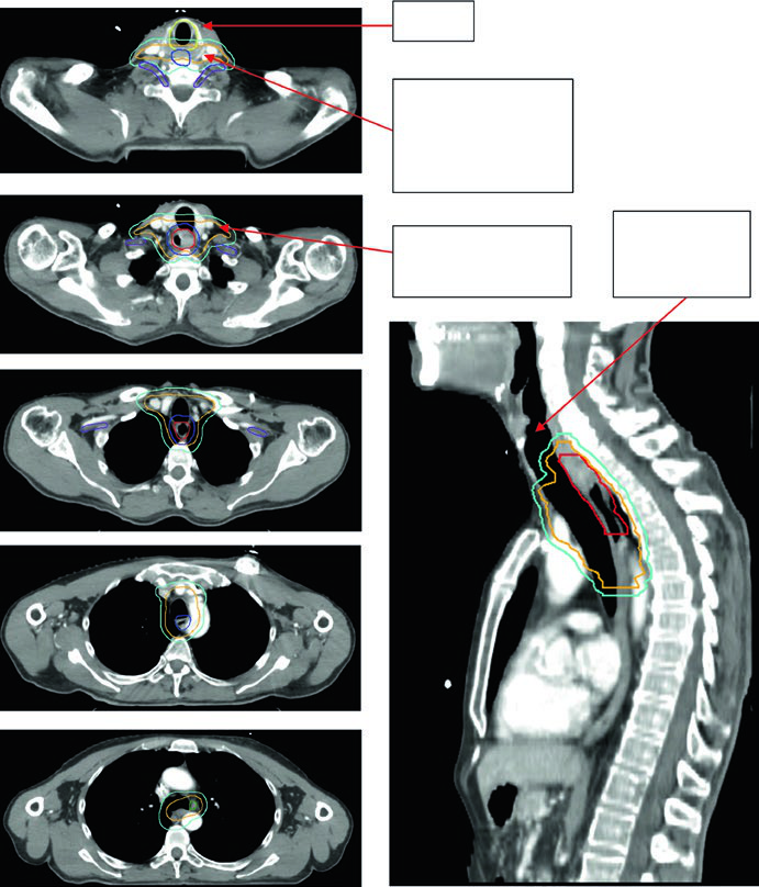Radiation planning contours for cervical esophageal SCC with bilateral supraclavicular nodal coverage