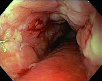 Endoscopy showing partially obstructing circumferential esophageal adenocarcinoma 31-35 cm from incisors