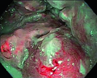 Endoscopic ultrasound showing T3 primary disease and suspicious level 4R lymph node in esophageal cancer
