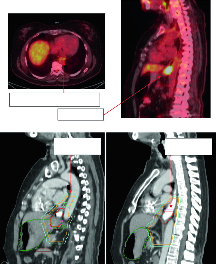 PET-CT and sagittal planning CT for gastroesophageal junction adenocarcinoma uT3N2 with FDG-avid paraesophageal node