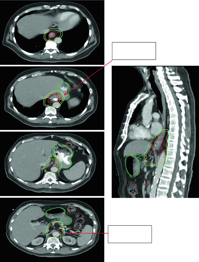 Radiation planning contours for gastroesophageal junction adenocarcinoma uT3N0 with celiac axis coverage