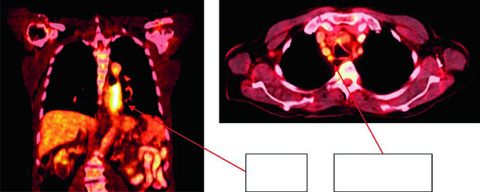 PET-CT of lower thoracic esophageal adenocarcinoma uT3N1 showing primary uptake and level 4R paratracheal lymph node