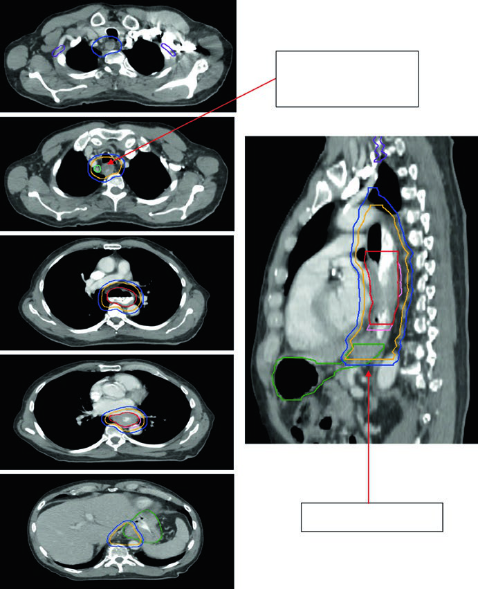 Axial planning contours for lower thoracic esophageal adenocarcinoma showing 0.5 cm GTV-to-CTV margin at level 4R node and 3-4 cm inferior coverage