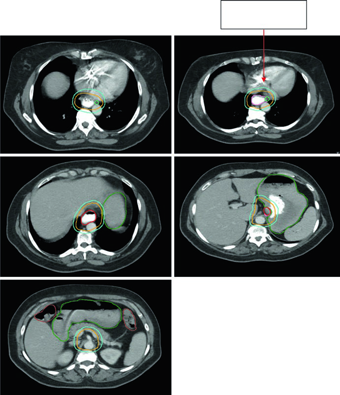 Axial contours showing inclusion of paraesophageal lymph node in CTV for gastroesophageal junction adenocarcinoma