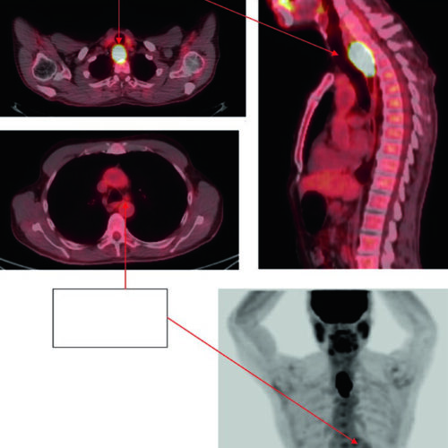 Câncer de Esôfago: Delineamento e Campos na RT