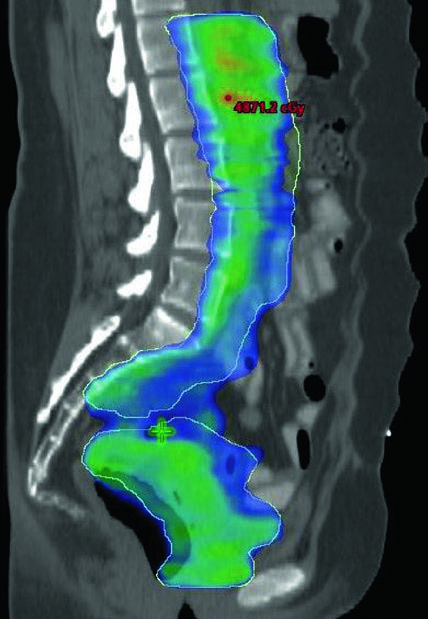Sagittal cross-section of planning CT with prescription isodose colorwash in endometrial cancer patient receiving postoperative extended field radiation therapy with PTV extending to L1